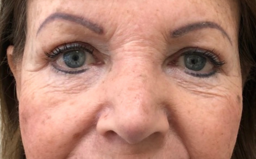 GG After Upper and Lower Blepharoplasty
