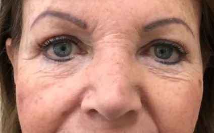 GG After Upper and Lower Blepharoplasty