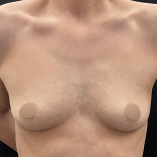 Cadogan Clinic WS Breast Augmentation Before