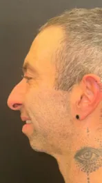 SP Before Male Rhinoplasty Profile