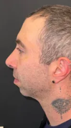 SP After Male Rhinoplasty Profile