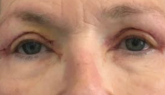 EH After Upper Blepharoplasty