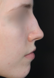 TJ Before Septorhinoplasty