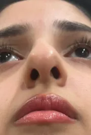 MA Septoplasty Before pt.1