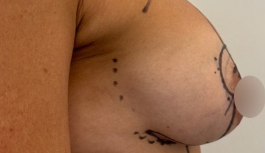 WVN Before Mastopexy & Implant Exchange Side