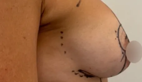 WVN Before Mastopexy & Implant Exchange Side