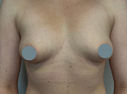 SSJ Breast Augmentation Before