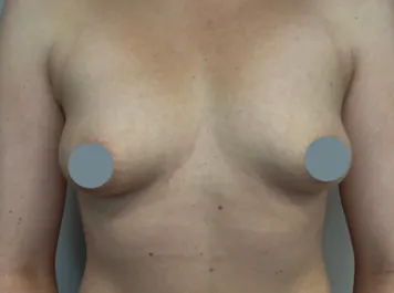 SSJ Breast Augmentation Before