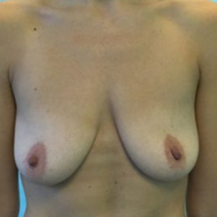 Breast Lift GG Before
