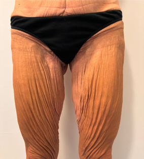 SSJ Thigh Lift Before