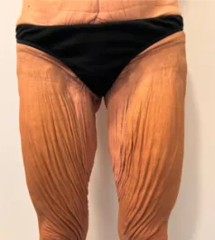 SSJ Thigh Lift Before