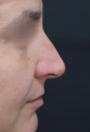 TJ Before Rhinoplasty