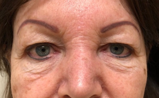 GG Before Upper and Lower Blepharoplasty