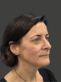 AN Rhinoplasty After