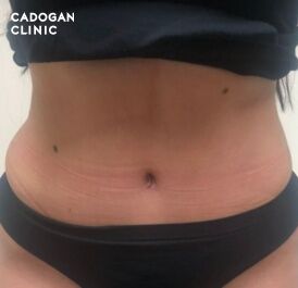 Lush How Can I Get A Free Tummy Tuck Capture Digital Art Lush How Can I Get A Free Tummy Tuck Capture Digital Art