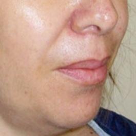 One Stitch Facelift  Micro Facelift London, UK Price & Cost