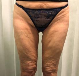 Thigh Lift London, Thigh Reduction Surgery UK