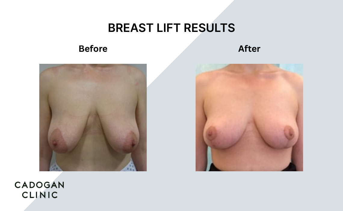Before and after images showing Breast Lift results