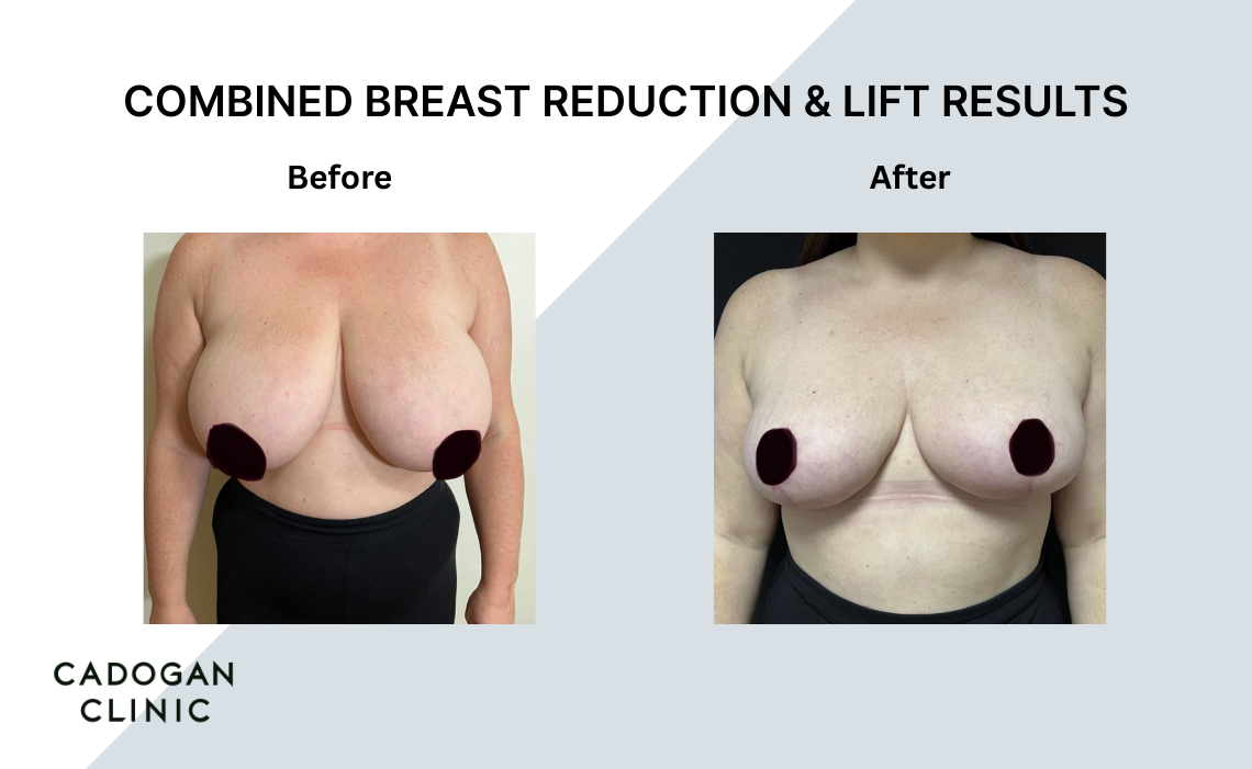 Before and after images showing Breast Reduction and Lift results