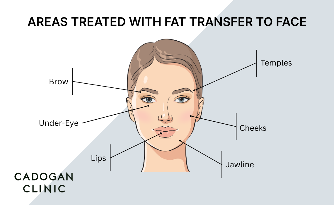 A diagram showing the popular areas treated with facial fat transfer