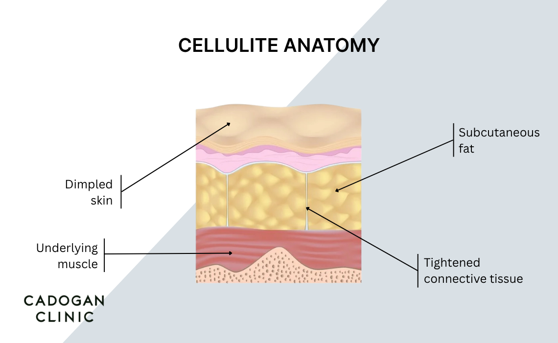 An infographic showing the anatomy of cellulite